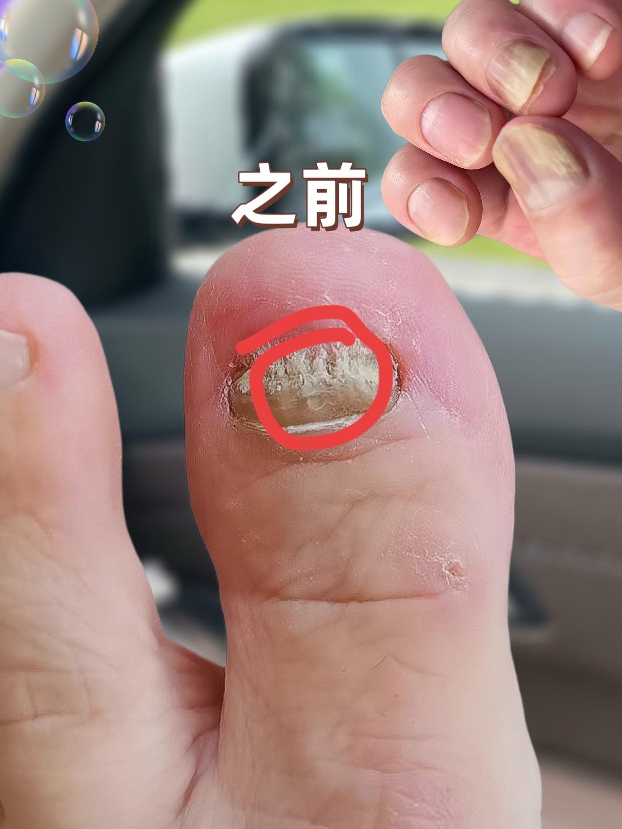 #灰指甲 #真实分享 #亲测分享 #自用好物分享 #爱了爱了 多年烦恼,终于上岸