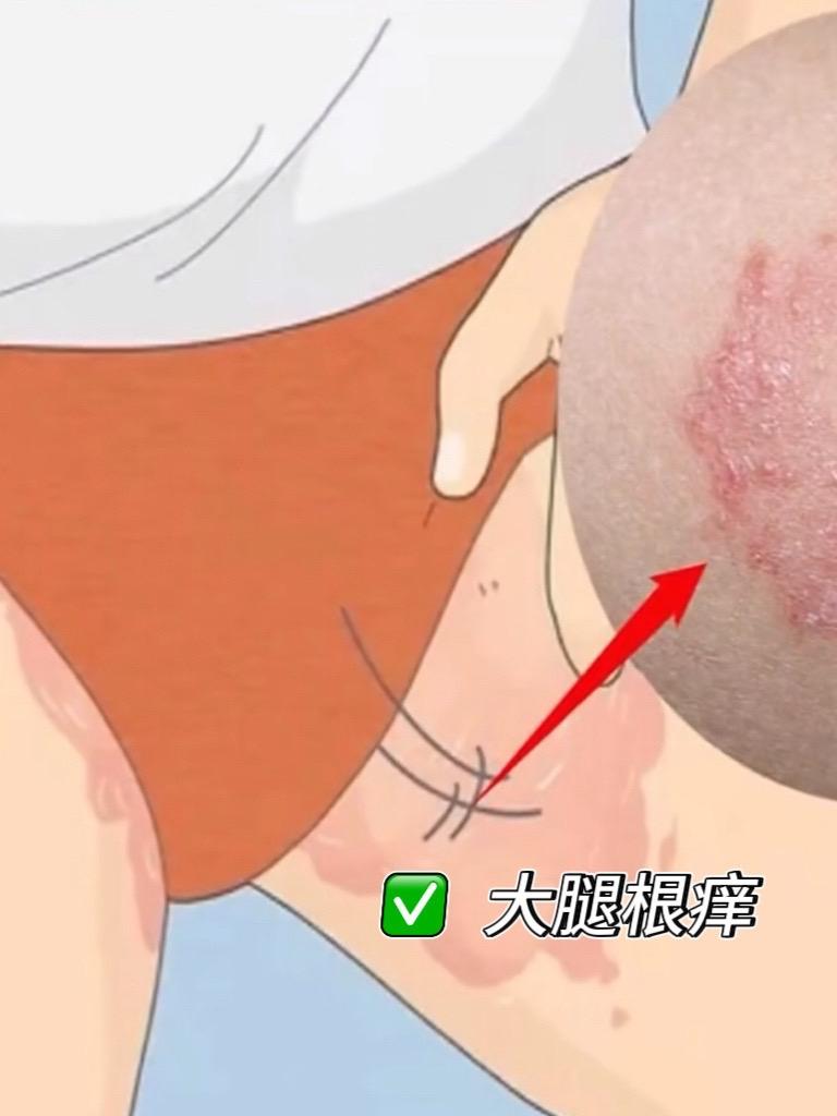 大腿根痒~就可以试试这个#草本安肌膏 里面添加了12种草本,涂抹上冰冰凉凉的,很舒服,#生活小妙招 #男生女生皆可用