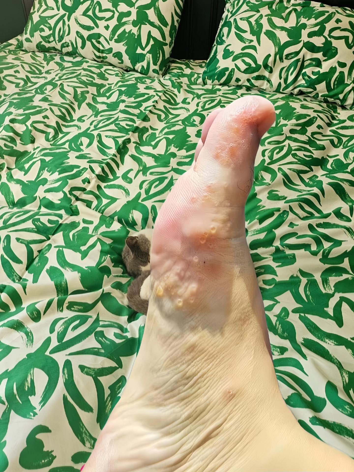 终于不痒不臭了,老牌子用着放心~太开心了#万万没想到 #可爱的小脚丫 #足部护理 #无处安放的小jio