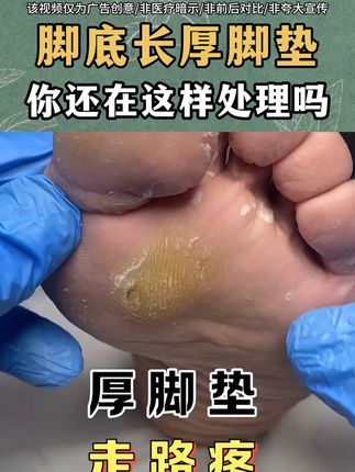 脚底厚脚垫走路疼痛怎么办呢,千万别拖#老茧 #老茧怎么去除 #鸡眼 #鸡眼去除小妙招 #脚底板的老茧怎么清除