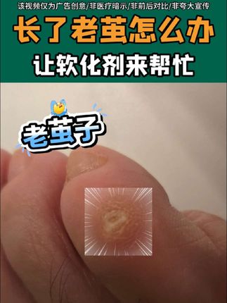 长了老茧怎么办#老茧 #老茧怎么去除 #鸡眼 #鸡眼去除小妙招 #足部护理