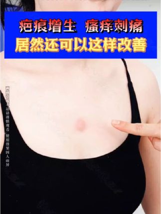 疤痕瘙痒不拖,改善会有多简单 #疤痕 #疤痕体质 #淡疤 #淡疤小行家 #淡疤膏