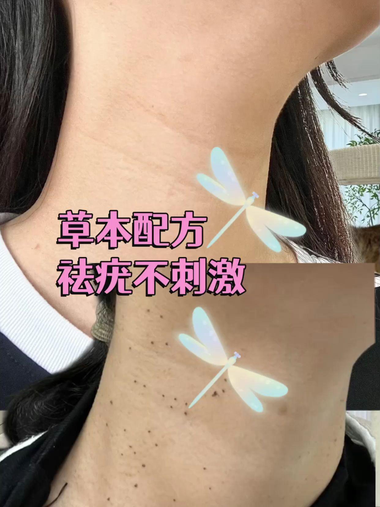 江源棠清优灵小肉粒优膏草本萃取多人群适用涂抹外用乳膏