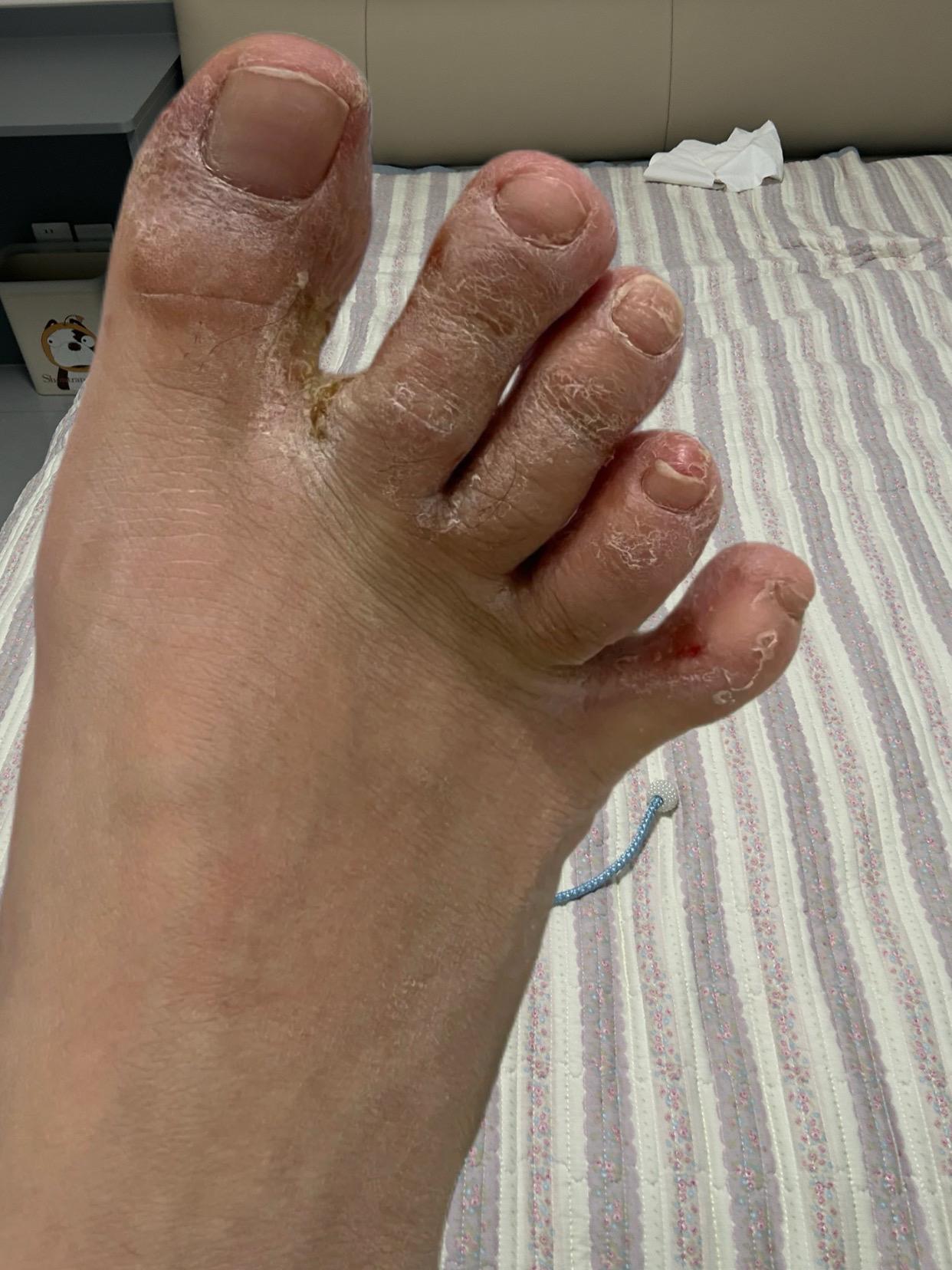 终于不痒了,不臭了,真的好开心!#足部护理#无处安放的小脚丫 #夏天该有的样子#自信最美