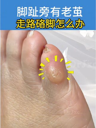 再厉害的老茧也怕它,不满意放心退#老茧 #老茧怎么去除 #小脚趾长硬茧怎么办 #强烈推荐 #足部护理