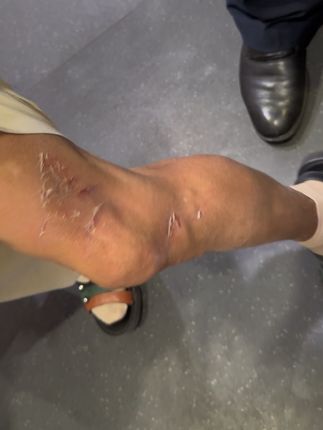 这是我的奶奶今年七十二岁了,她很善良,是一个很好的奶奶,这次在杭州照顾了我十多天,昨天上车把脚摔倒了,其实很痛她却一直安慰我没事的,说这点痛不算什么,只要我们身体好她吃多少苦都没事,我真的心里不是滋味,我想如果有一天我能有机会换零件,我一定让她不在这么辛苦,好好孝顺她#奶奶 #家
