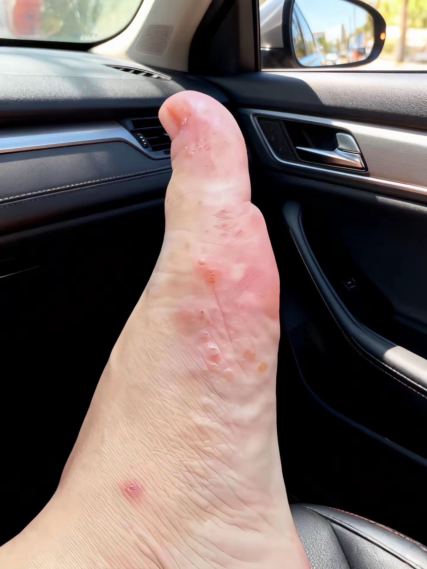 终于不痒不臭了,老牌子用着放心,好开心~#万万没想到 #可爱的小脚丫 #足部护理 #无处安放的小jio