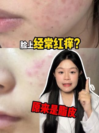 你脸上是不是经常红,痒?起皮掉屑?#脂皮 #护肤 #泛红 #起皮卡粉 #痘痘