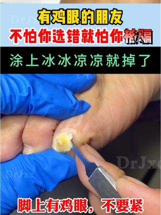 有鸡眼的朋友认准正品,鸡眼脱落真的猛#鸡眼 #鸡眼跖疣 #鸡眼去除小妙招 #鸡眼机 #鸡眼扣