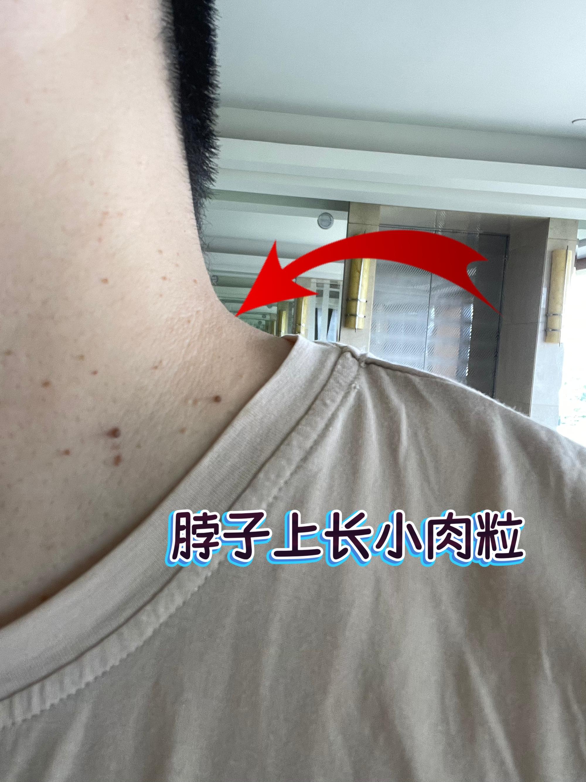 脖子长肉粒 用1次就够了。#热门 #小肉粒 #丝状疣 #扁平疣 #脖子上的小肉粒