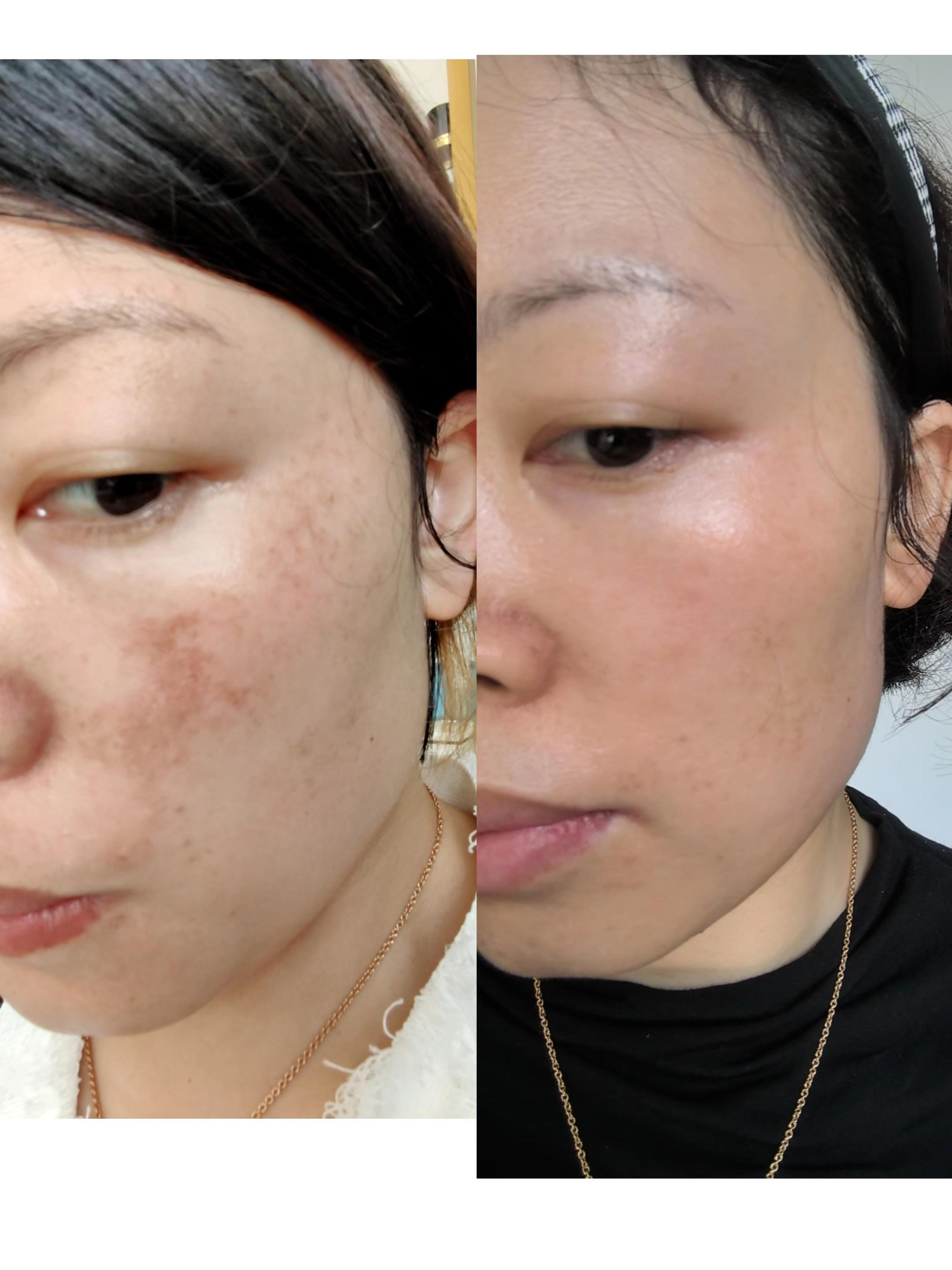 皮肤长斑的小姐姐们,维娜雪肌美白套淡斑效果超级好,收到货后联系我,我教你如何使用!内调➕外用,让你的肌肤变美逆袭!