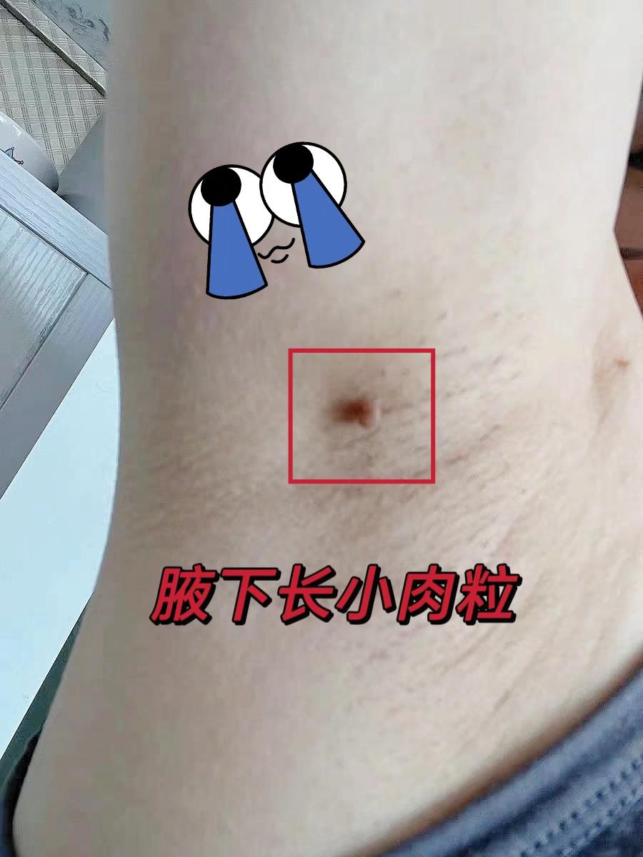 腋下长小肉粒。#小肉粒 #扁平疣 #丝状疣 #扁平疣祛除 #丝状疣祛除