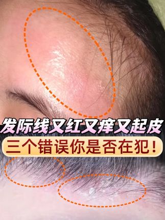 发际线一圈又红又痒又起皮 这是顽固的脂皮!看看这三个错误你是否在犯!用脂皮ds水乳,科复美龙胆乳!#泛红 #痒 #起皮 #护肤 #皮肤管理