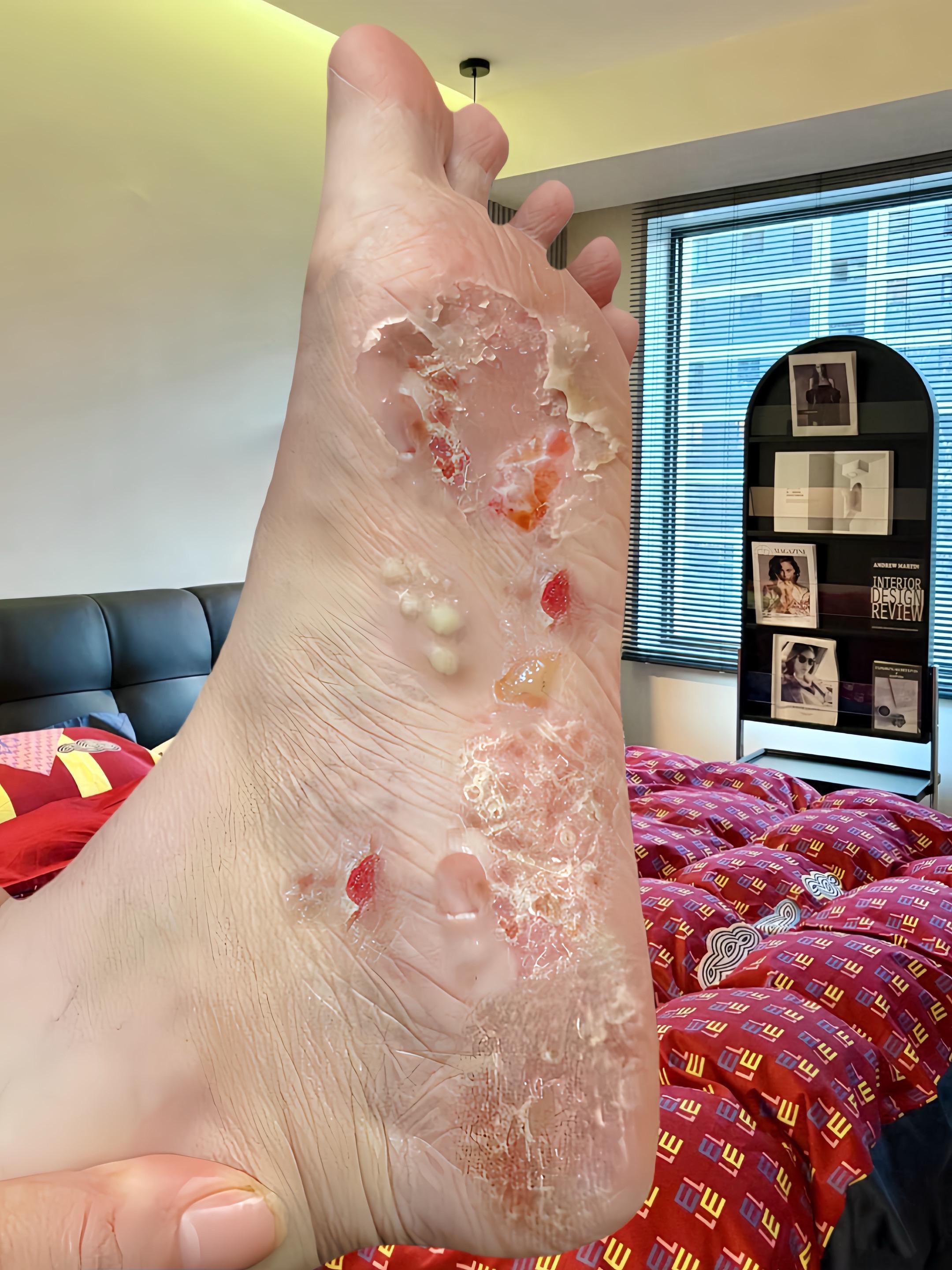 终于不痒了,不臭了,真的好开心!#足部护理#无处安放的小脚丫 #夏天该有的样子#自信最美