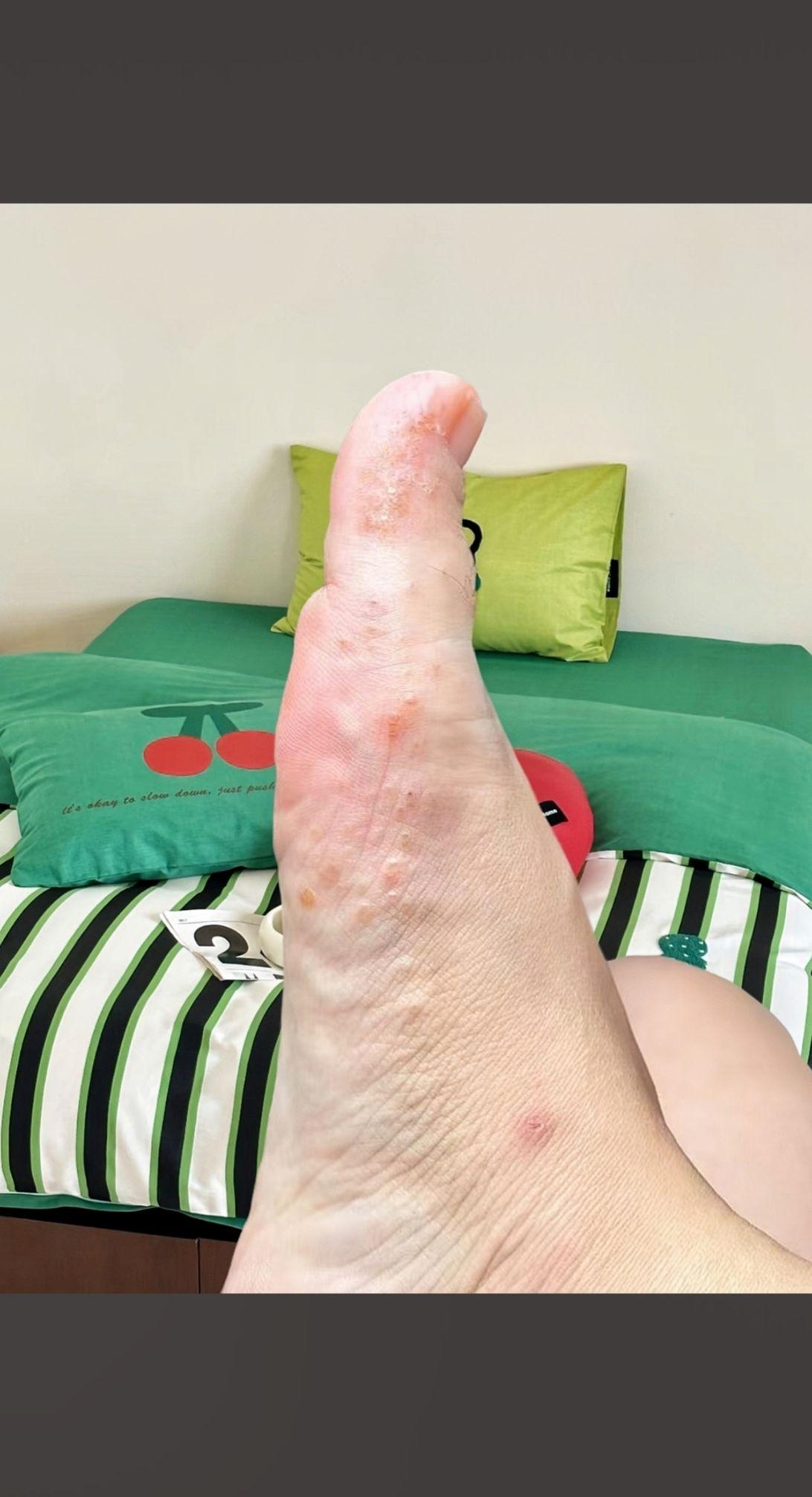 终于不臭不痒了,太好了!老牌子用着放心!#万万没想到#无处安放的小脚丫 #足部护理