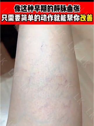像这种早期的静脉曲张,只需一个简单动作就能帮你改善#静脉曲张的最快消除方法 #下肢静脉 #静脉曲张怎么改善 #静脉曲张老烂腿 #蚯蚓腿