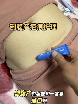 #剖腹产 剖腹产妈妈坚持涂凝胶,也要忌口,腥辣刺激食物尽量不要吃,每天坚持涂凝胶四到五次、#剖腹产疤痕护理