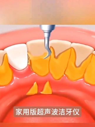#洁牙仪 #洁牙仪牙结石清洁牙垢洗牙工具 #洁牙仪器