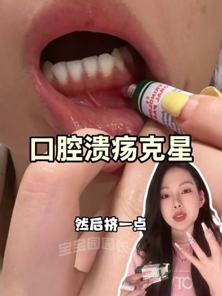 我也是上岸了,真的超好用!#种草 #上火了 #口腔溃疡怎么办 #trinolone口腔膏