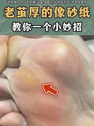 脚上有老茧的,我教你个小妙招#老茧 #老茧怎么去除 #鸡眼 #鸡眼去除小妙招 #脚底板的老茧怎么清除