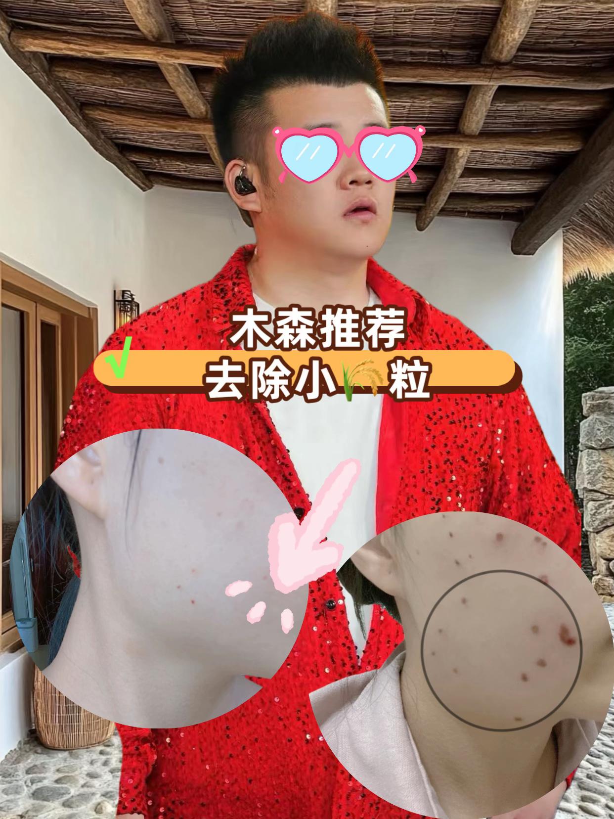【小肉粒专用】颈部脖子小疙瘩身上手足腋下丝状扁平肉刺草本克尤膏