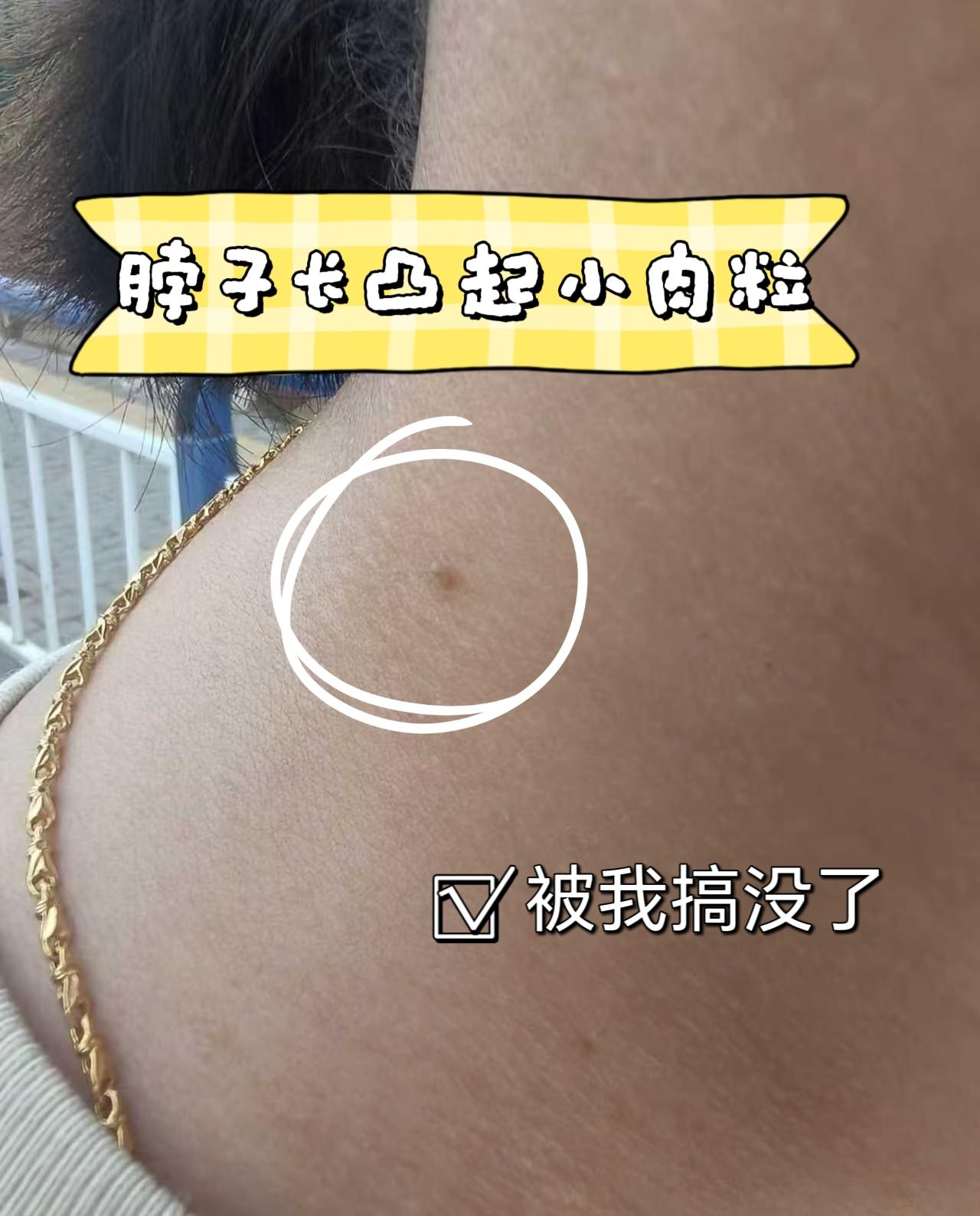 脖子上长小肉粒,拜拜。#小肉粒 #扁平疣 #丝状疣 #丝状疣祛除 #脖子上的小肉粒