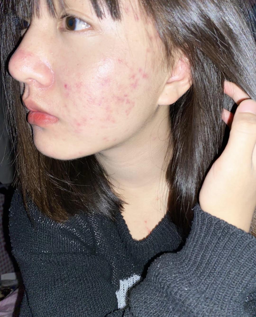 脸上痘痘多用它姐妹们#痘痘 #毛孔粗大 #黑头