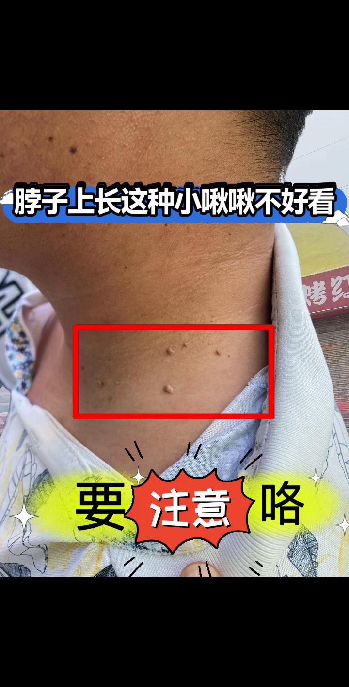 脖子不好看没关系呀,像我一样坚持就是胜利✌️✌️现在也成了别人口中羡慕的对象,好开心呀#脖子上的开关 #肉粒 #脖子护理