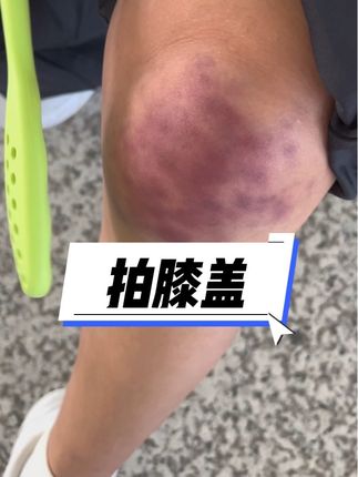 回复 @阳光的评论 #拍痧 #扣痧 #拍痧板 #拍打