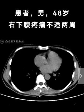 今日案例分享 可诊断出什么? #医学影像 #医学影像学 #ct #学习打卡 #人民卫生电子音像出版社