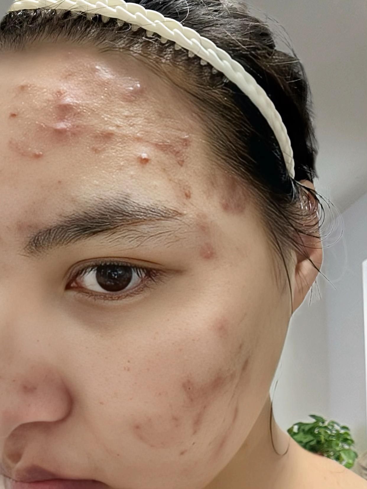 姐妹困扰多年,现在终于不自卑了,干净光滑的皮肤就是颜值的加分项#日常分享 #皮肤 #护肤 @抖加🔥上热门🔥dou+🔥热点宝 @DOU+上热门