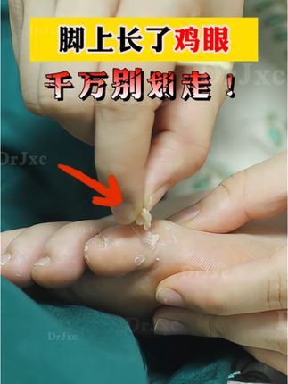 鸡眼自然脱落啦,没想到好几年的鸡眼这么简单#鸡眼 #鸡眼跖疣 #鸡眼去除小妙招 #鸡眼机 #鸡眼扣