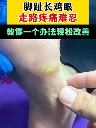脚上长鸡眼老茧的朋友千万别再错过这条视频,快来试试这个好东西 #鸡眼跖疣 #鸡眼去除小妙招 #鸡眼 #鸡眼肉刺 #老茧怎么去除