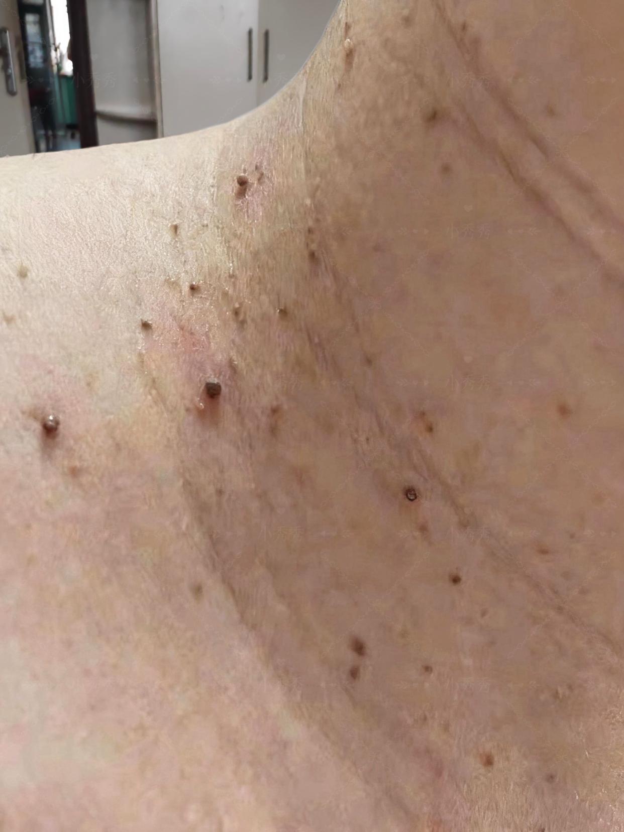 身上有这种小肉粒的朋友注意了!这个是我们工厂生产的清优灵小肉粒优膏,专门针对身上各种小肉粒的,不管是几年的小肉粒都能用它,只需要轻轻一抹就可以解决你的烦恼。