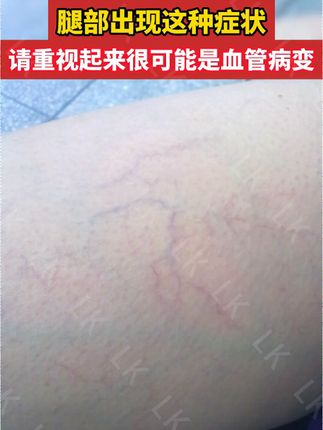 腿部出现这种情况,请重视起来#静脉曲张 #静脉曲张的最快消除方法 #静脉曲张怎么办 #静脉曲张怎么改善 #青筋凸起