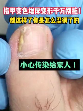 #灰指甲 都这样了,你怎么能忍下去的#指甲变黄 #指甲变厚 #灰指甲一个传染俩 #指甲变形