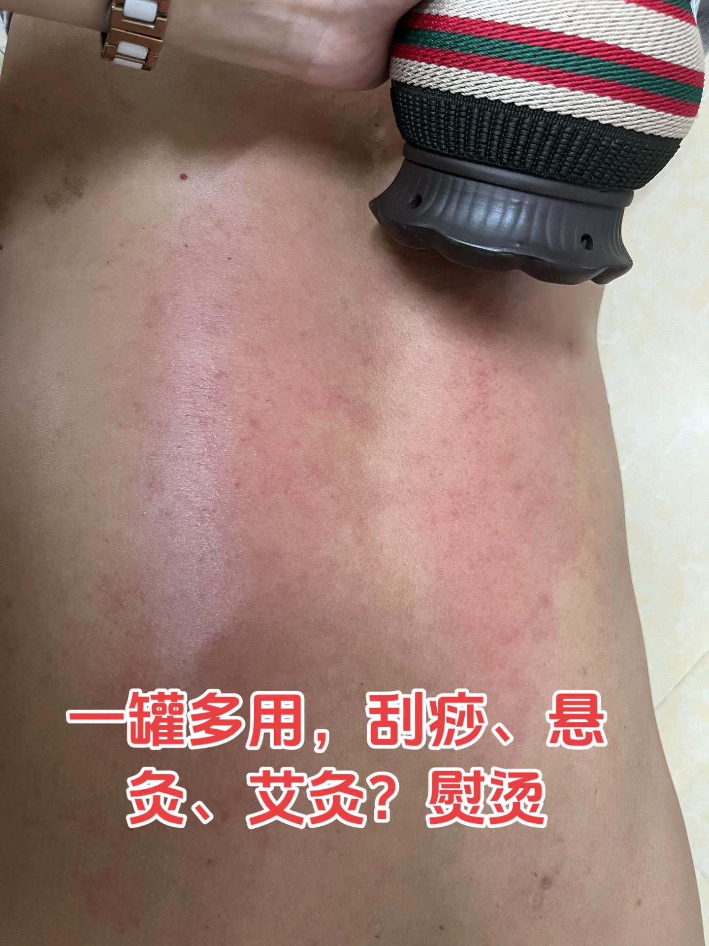 一罐多用,哪里不舒服灸哪里#疏通经络 #调理身体 #健康 #养生保健#颈肩疼痛 家中常备