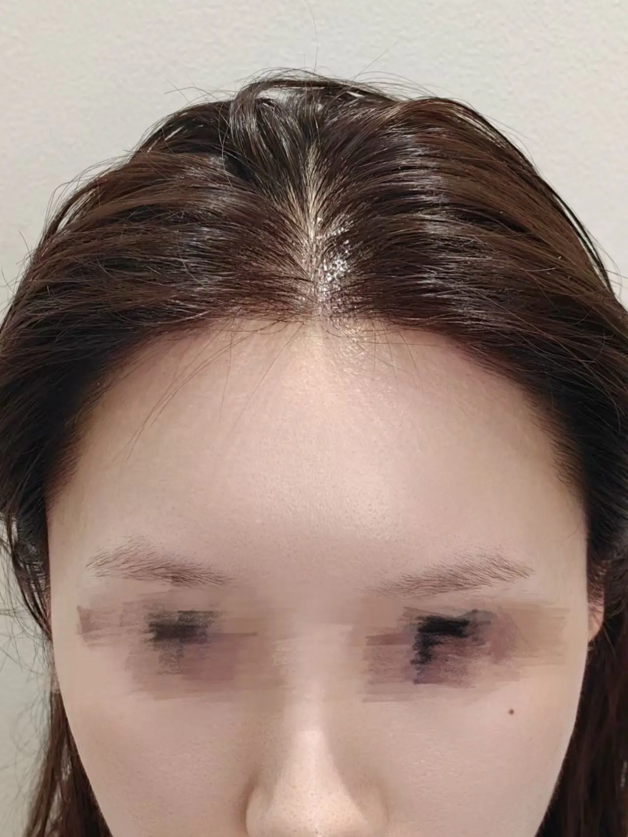 上海做的发际线就这?洗完头吹干,风筒不敢开太热不敢靠太近,生 - 抖音
