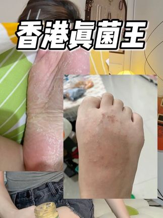 终于知道是啥原因了,用对才管事儿~#真菌 #香港 #老国货
