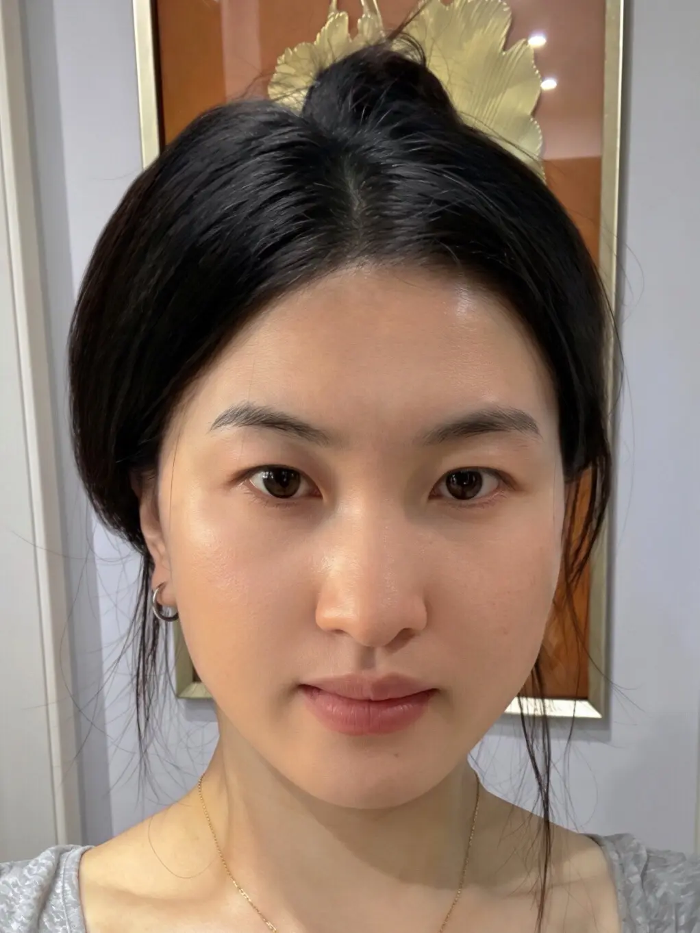44岁,去上海做了提升,现在状态怎么样?#面部提升 #抗衰逆 - 抖音