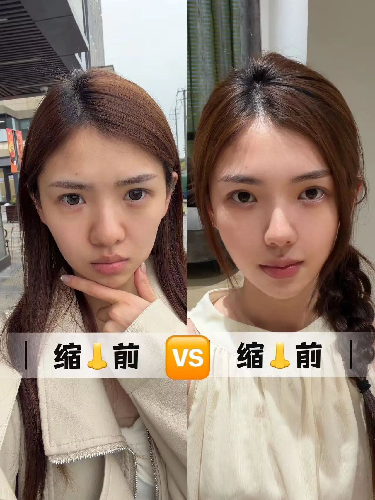 从小因为鼻子大感觉很自卑... #缩鼻翼 #鼻翼缩小 #上海 - 抖音