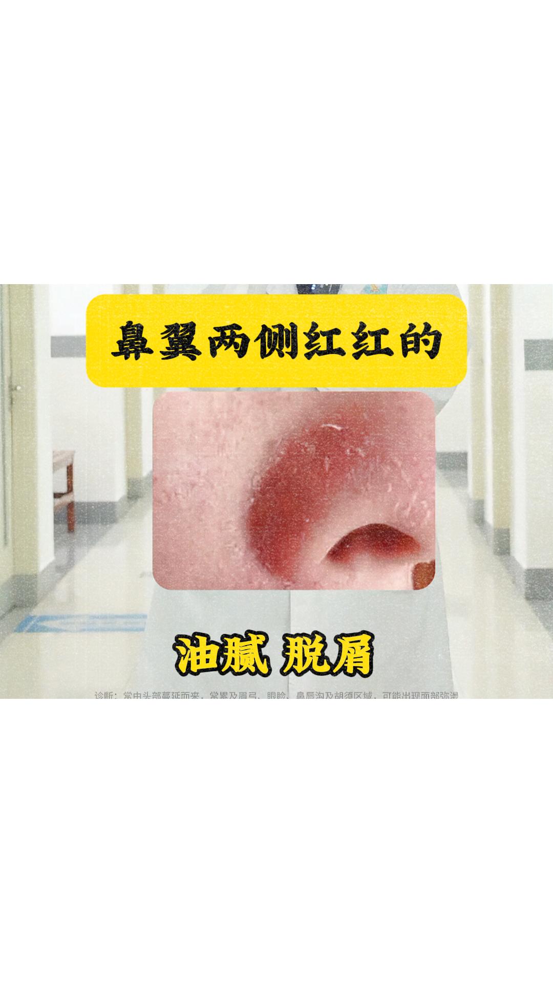 鼻翼两侧总发红还油腻腻的脂溢性皮炎怎么处理 #脂溢性皮炎 #敏感肌 #护肤 #女生必看 #硬核健康科