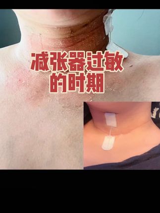 #甲状腺癌术后 术后这段时间心路历程只有自己知道,没有紧张、没有恐惧、没有眼泪、也没有焦虑,就这样平静地接受了,每天看着这道疤痕会觉得对不起自己,替自己的身体很委屈,在任何时期 任何角色里自己都问心无愧,对得起任何人,却唯独对不起自己,没有好好爱惜自己的身体,这是最错误的!对抗会很幸苦,接受才是正确选择,接受自己的病,接受这道疤,时刻警惕自己今后一定要爱惜自己,总要在这场病中觉悟出一些道理,才对得起你失去的健康和身体招过的罪…#甲状腺结节 #甲状腺癌 #甲状腺手术后的真实状态