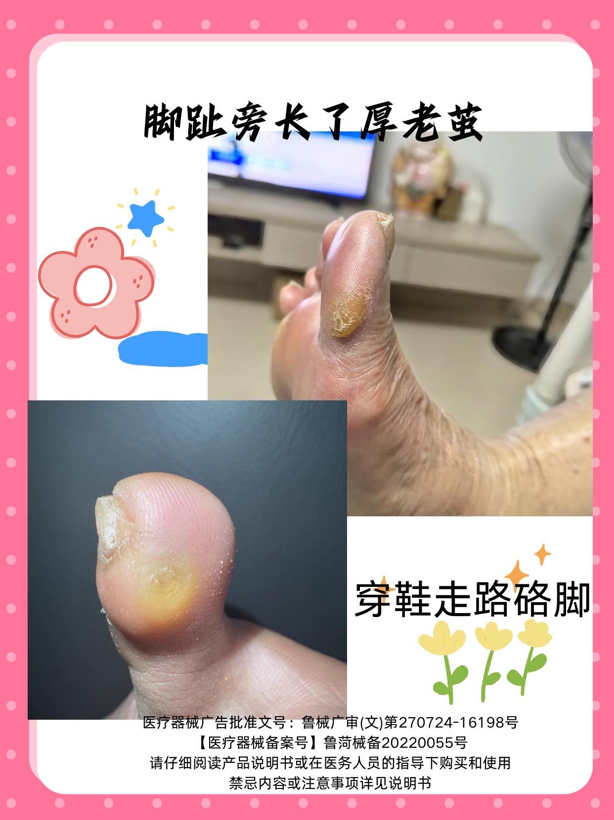 脚趾旁长了厚茧子怎么办。#怎么去除脚上老茧 #老茧痛怎么办 #老茧祛除 #告别老茧 #脚上长老茧怎么办