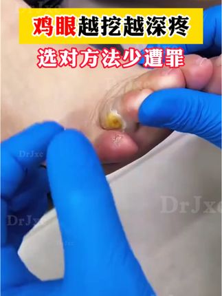 鸡眼越挖越深,一个方法自然脱落#鸡眼 #鸡眼跖疣 #鸡眼去除小妙招 #鸡眼机 #鸡眼扣