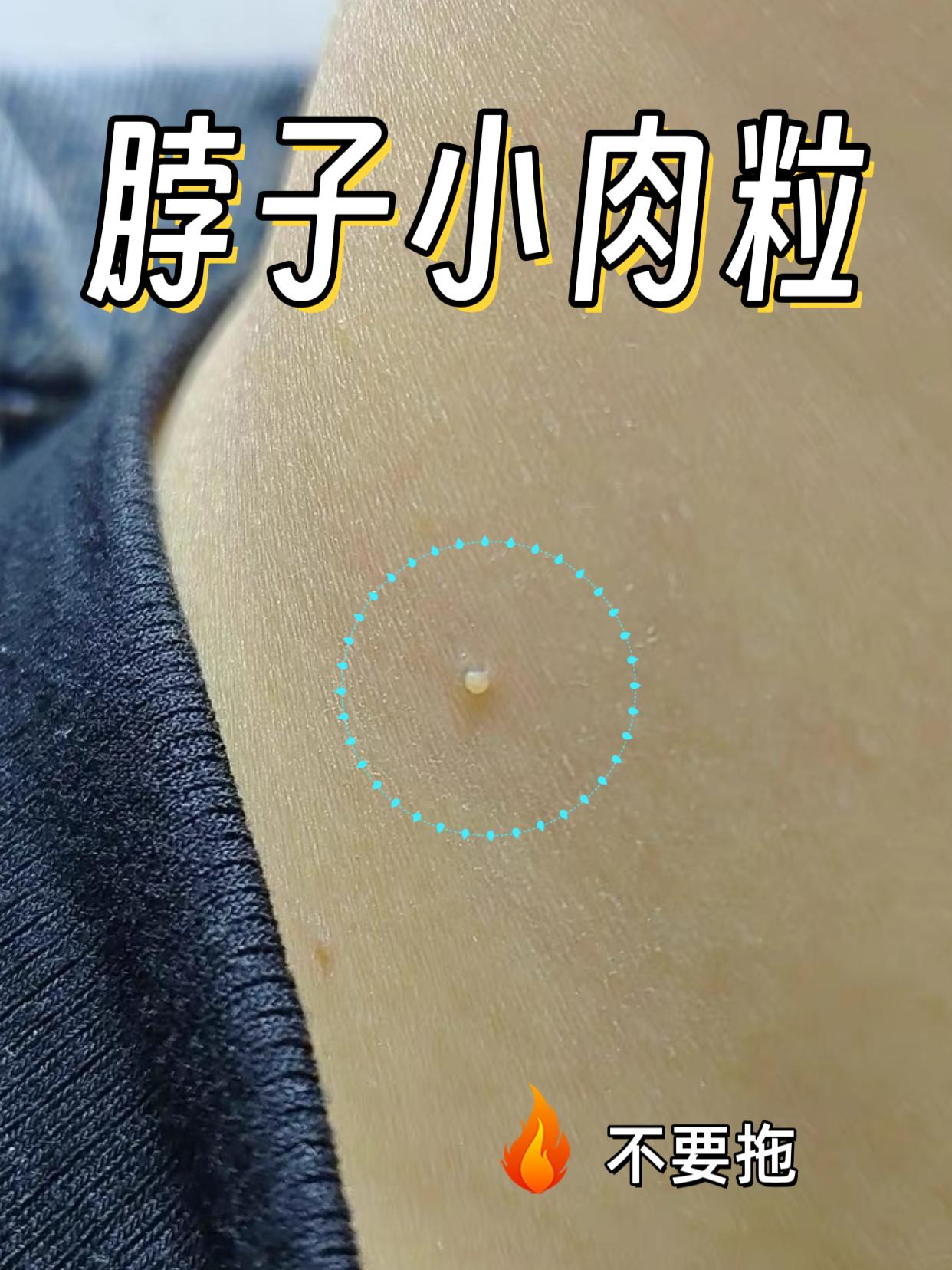 发现了好东西自然是第一个分享给你呀!#脖子上的小肉粒 #丝状疣 #丝状疣祛除 #疣