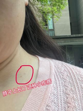 #上热门 日常生活中,很多人长有小颗粒,小肉球小疙瘩,赶紧来涂这款优膏吧!#必备好物 #优膏 #好物推荐🔥
