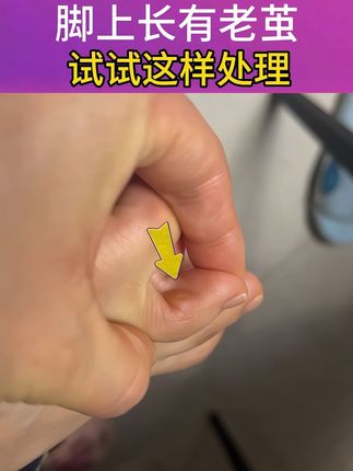 脚上长有老茧,影响穿鞋怎么办?#老茧 #老茧怎么去除 #老茧子 #老茧祛除 #老茧硬皮怎么祛除