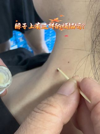 @佰草钟医绿客源专卖店手足护理6号 #脖子上的小肉粒 #脖子上长小揪揪 #疣【第一类医疗器械备案号/产品技术要求编号】鲁菏械备20220055号仔细阅读产品说明书或在医务人员的指导下购买和使用 禁忌内容或注意事项详见说明书 内容仅供参考,如有不适请线下就医