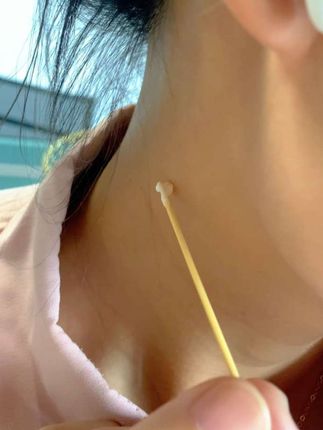 #脖子上的小肉粒 #变美就是这么简单 #女性健康